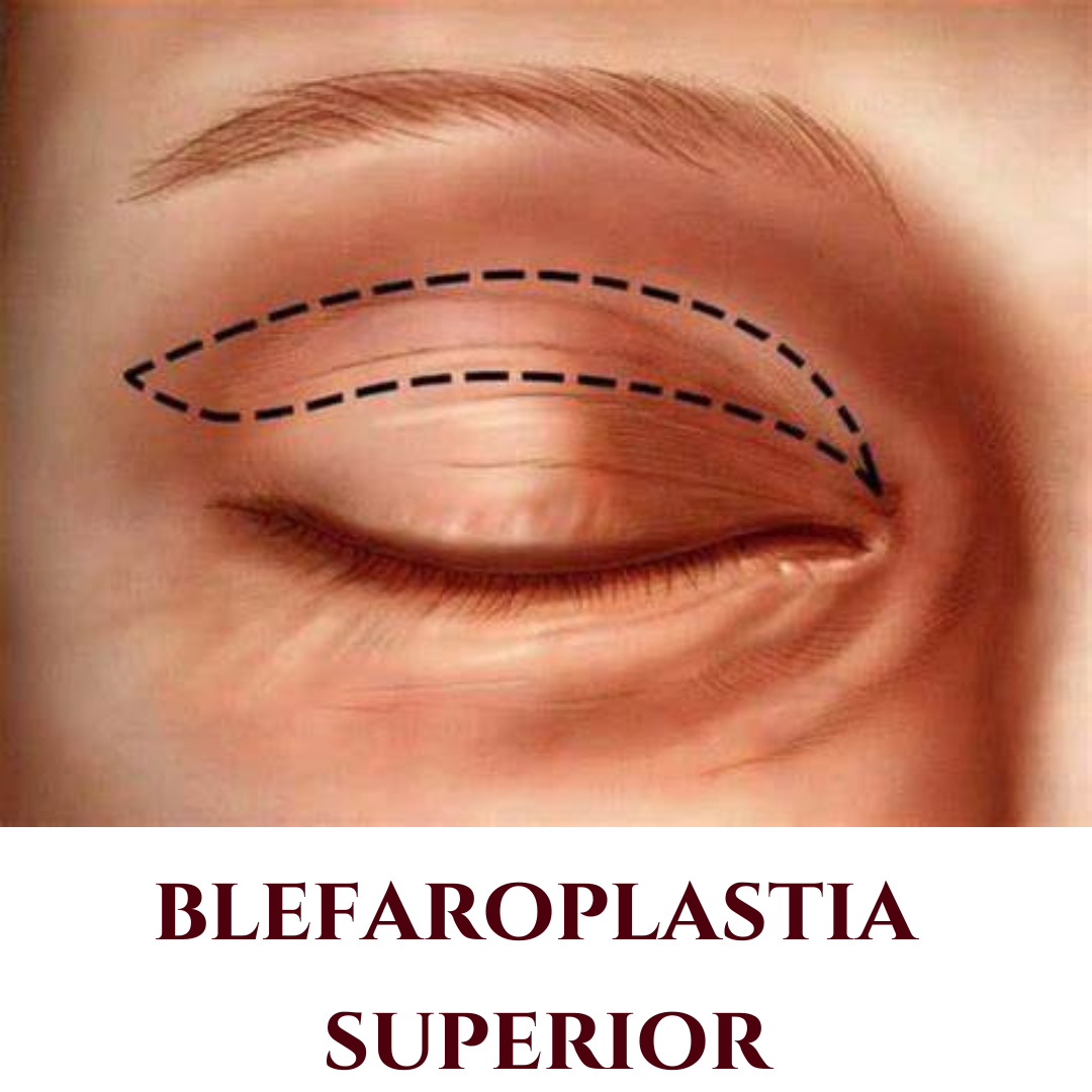 blefaroplastia superior valinhos - blefaroplastia superior vinhedo - blefaroplastia superior campinas