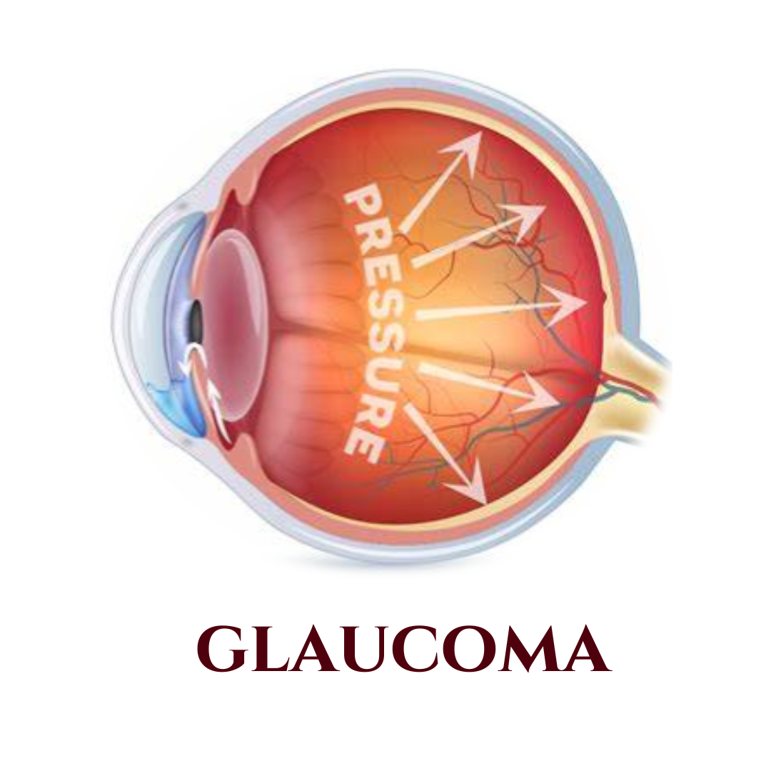 Glaucoma Valinhos - Glaucoma Vinhedo - Glaucoma Campinas