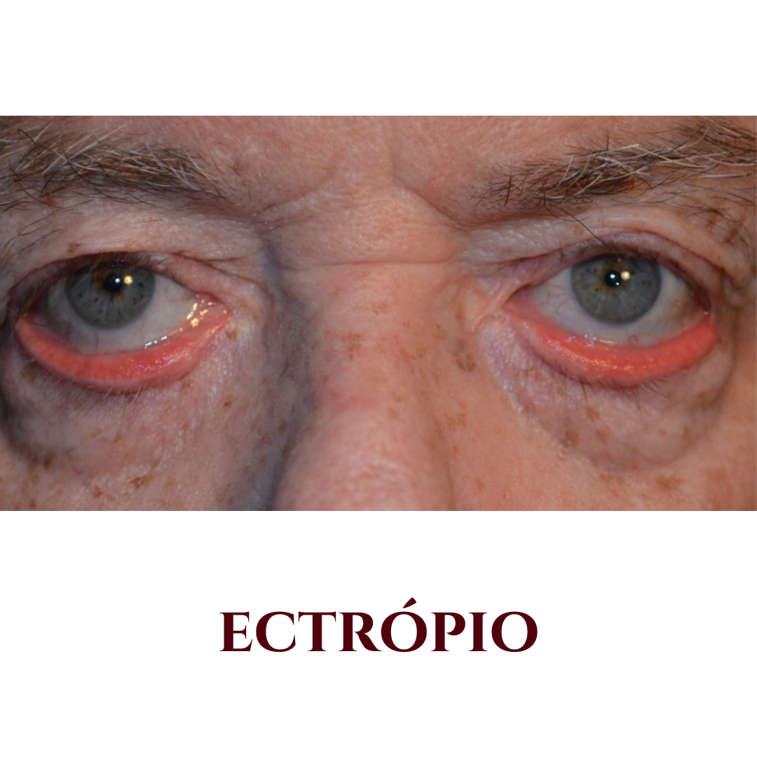 ectrópio valinhos - ectrópio vinhedo - ectrópio campinas