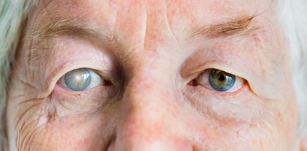 cataratas-ocular-catara-o-que-e.jpg