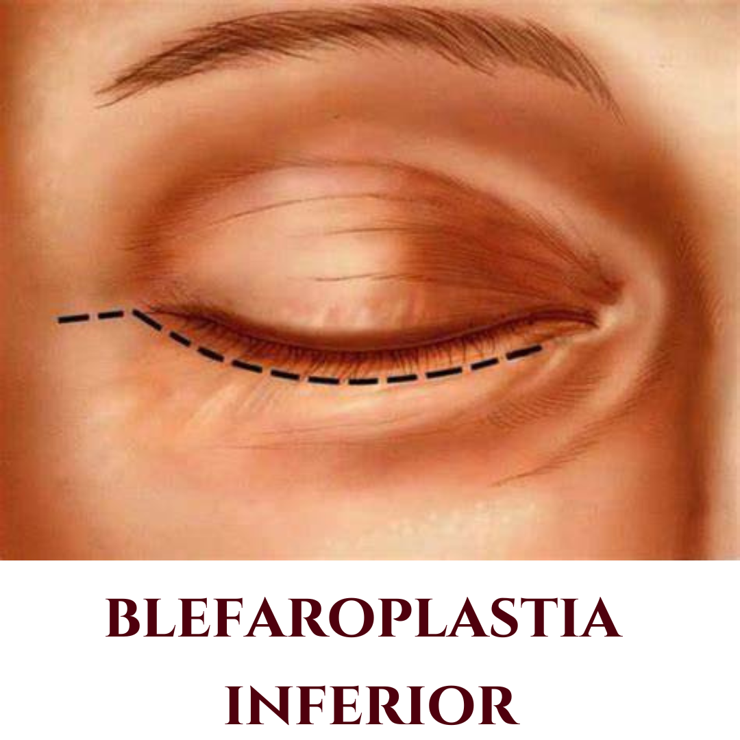 blefaroplastia inferior valinhos - blefaroplastia inferior vinhedo - blefaroplastia inferior campinas